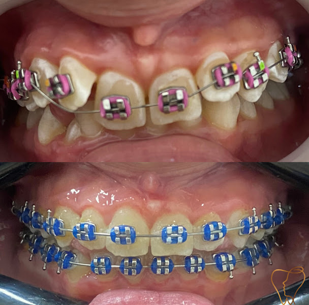 Foto 3 de Felicíssimo Odontologia| Lentes de Resina e Ortodontia