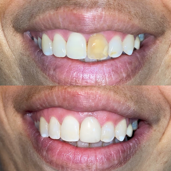 Foto 3 de Fernanda Frizzo - Dentista - Invisalign - Lentes de Resina