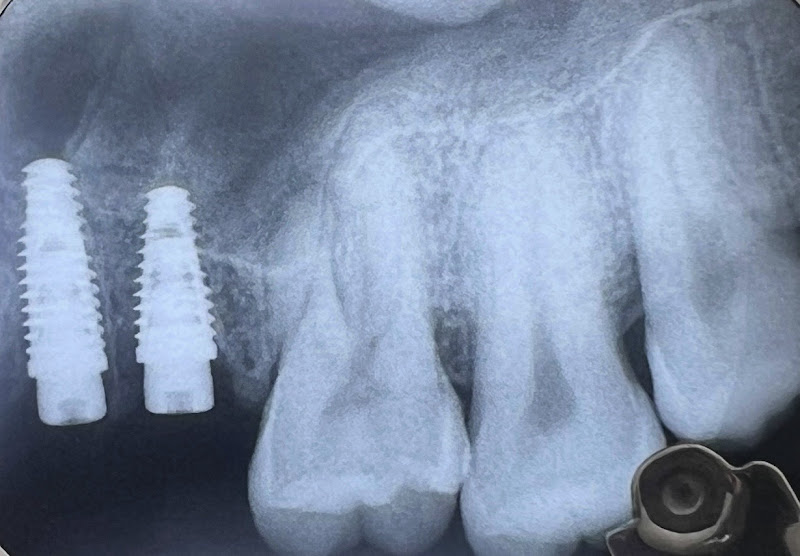 Foto 3 de Fonsêca Odontologia | Implantes