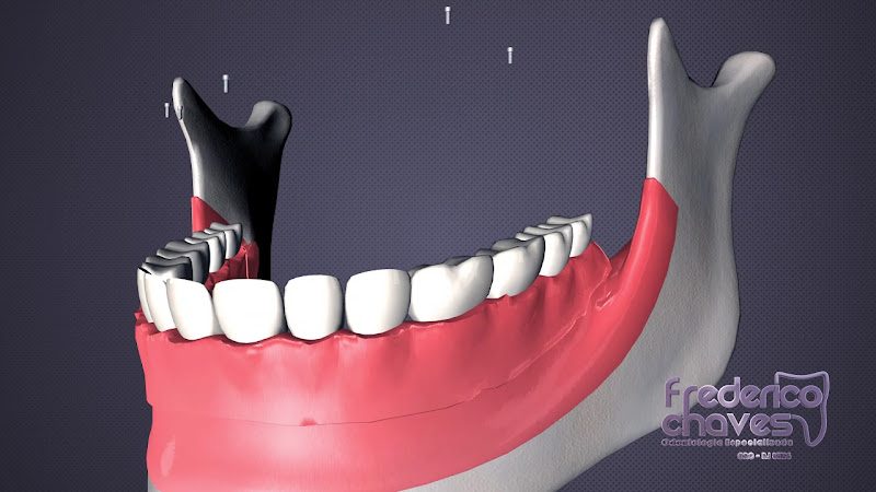 Foto 3 de Frederico Chaves Implantes e Reabilitação Oral