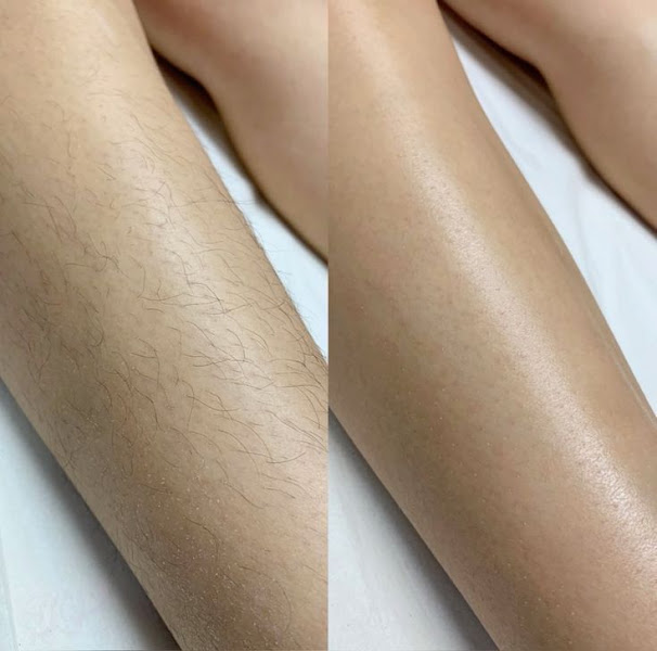 Foto 2 de Go Laser - Clinica Estética Jacareí