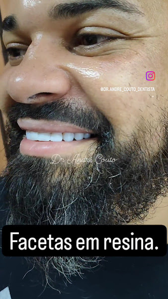 Foto 3 de ( GRAJAU DENTISTA - SP) Dr. André Couto (IMPLANTES AVANÇADOS) dentes fixos em 72 horas. (Sedação com Óxido Nitroso)