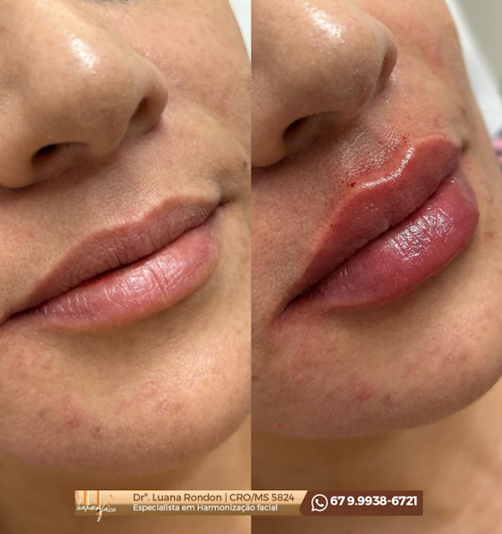 Foto 2 de Harmoface - Clínica de Estética - Harmonização Facial e Botox