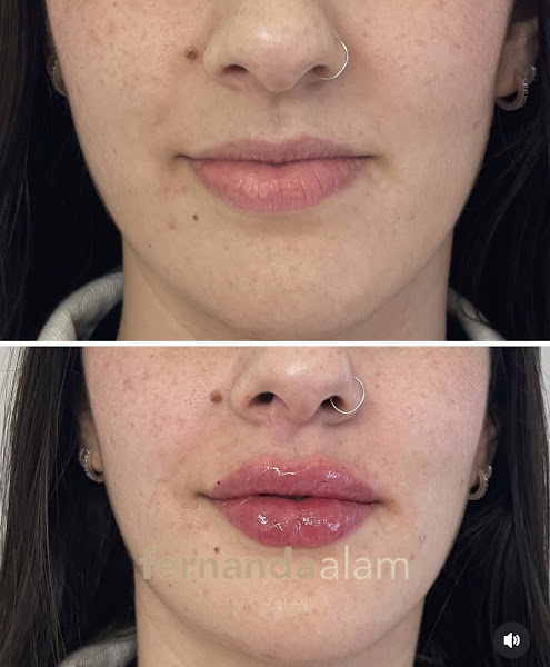 Foto 2 de Harmonização e estética Orofacial com Naturalidade - Fernanda Al-Alam