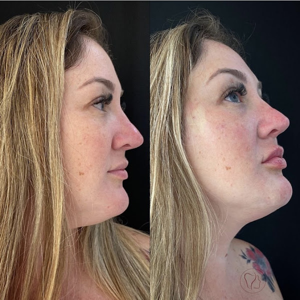 Foto 3 de Harmonização Facial BH - ID CLINIC - Dras Isabela e Daniela Dutra