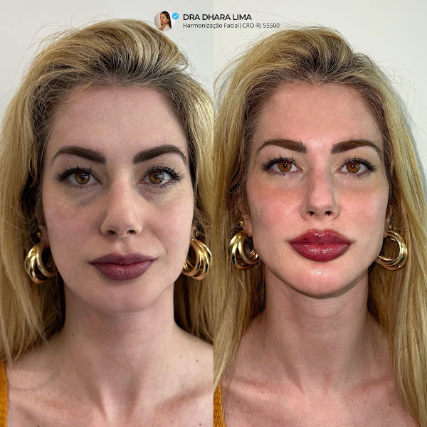 Foto 3 de Harmonização Facial Clínica Integrada Dra. Dhara Lima (estética e saúde)