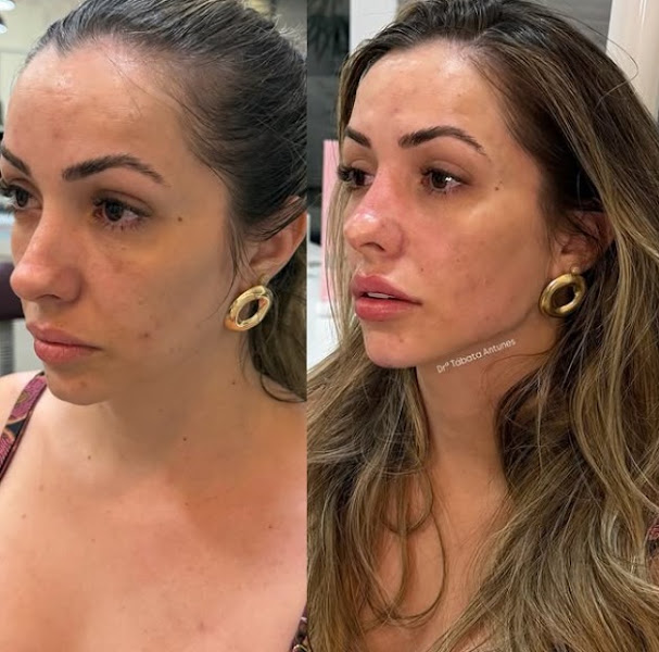 Foto 2 de Harmonização Facial | Dra. Tábata Antunes