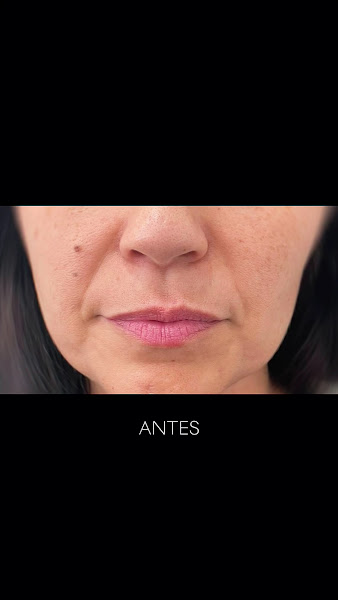 Foto 3 de Harmonização Facial e Corporal em São Luís - MA | Dra Taynara Pires