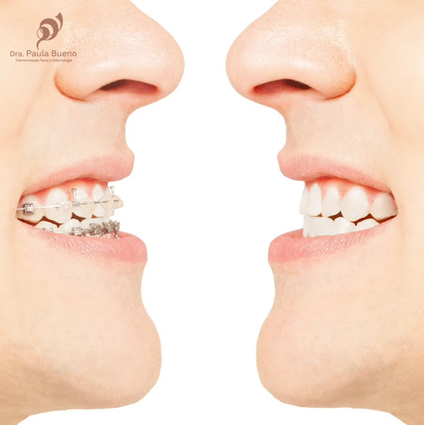 Foto 3 de Harmonização Facial e Odontologia em Balneário Camboriú | Dra. Paula Bueno