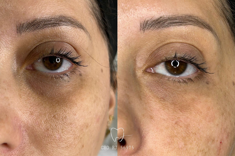 Foto 3 de Harmonização Facial Maricá | Dra Júlia Gomes