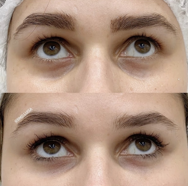 Foto 3 de Harmonização Facial | Preenchimento Labial | Botox - Dra. Luisa Giacomini em Porto Alegre