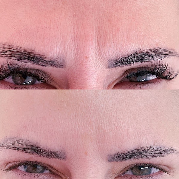 Foto 3 de Harmonização Facial| Preenchimento Labial| Clínica Estética| Toxina Botulínica