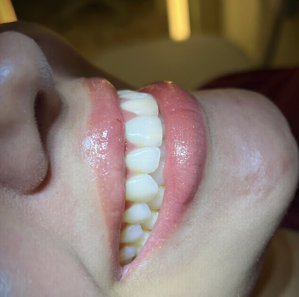 Foto 2 de HARMONIZAÇÃO • Mariana Inácio- Odontologia Restauradora e Estética