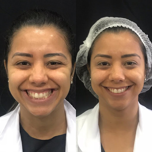 Foto 3 de Harmonização no Méier - Dr. Leonardo Drumond