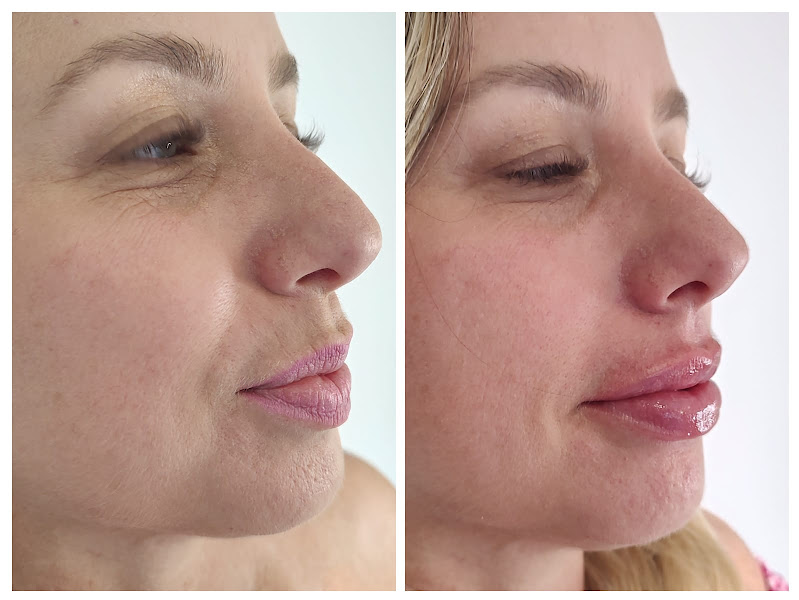 Foto 2 de Harmonização Orofacial Jundiaí - Dra. Mirella Lee