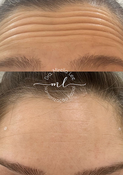 Foto 3 de Harmonização Orofacial Jundiaí - Dra. Mirella Lee