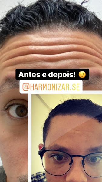 Foto 3 de Harmonizar-se Estética Facial - Centro Especializado em Harmonização Facial