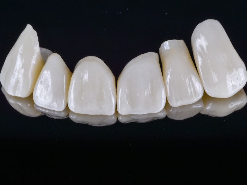 Foto 3 de Hillmann Saldini Odontologia | Bruxismo, ATM e Estética do Sorriso em Moinhos de Vento – Porto Alegre