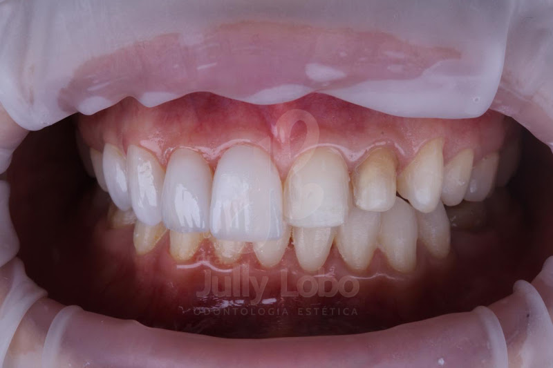 Foto 3 de Humanize Odonto l Dra Jully Lobo - Dentista - implantes - lentes - protese dental - botox - ortodontia - canal