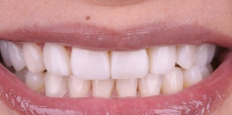 Foto 3 de Iessa Vieira Odontologia - Lentes e Facetas Dentais