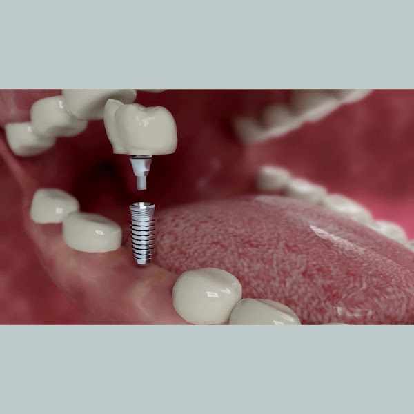 Foto 3 de Implant Class