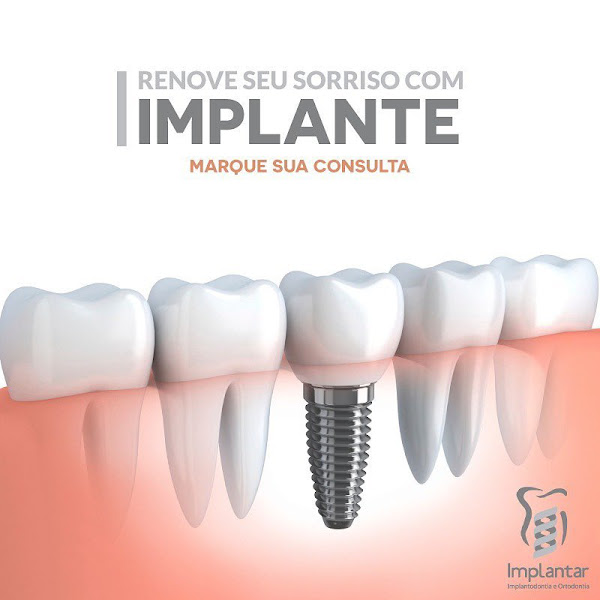 Foto 3 de IMPLANTAR- Clínica odontologica- Vitória da Conquista BA