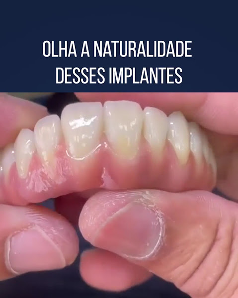 Foto 3 de Implante Dental Campinas