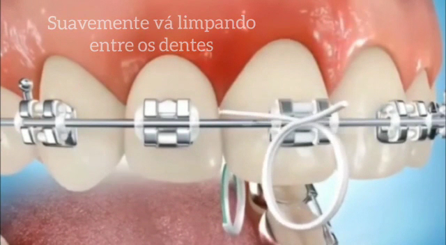 Foto 3 de Implante Dentário | Alinhador invisível SouSmile | Rise Odontologia | Campestre - Santo André