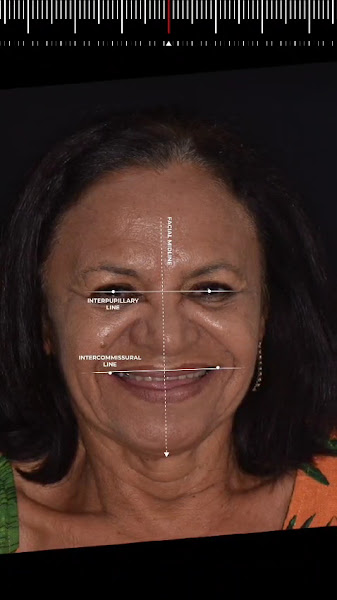 Foto 4 de Implante Dentário | Clínica Dental Design | Dentista em João Pessoa | Clínica Odontológica | Tratamento de Canal