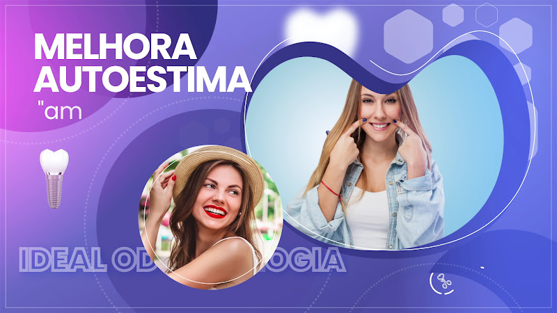 Foto 3 de Implante Dentário em Ceilândia | Dentista | Ideal Odontologia