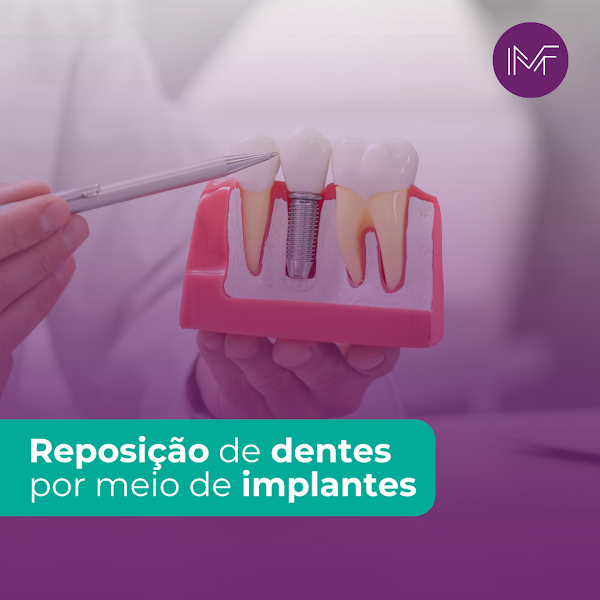 Foto 3 de Implante Dentário em São Luís - Moreira Figueirêdo | Odontologia