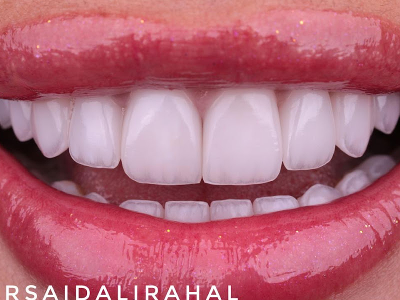 Foto 6 de Implante Dentário | Invisalign | Montagner Odontologia | Centro | Foz do Iguaçu - PR