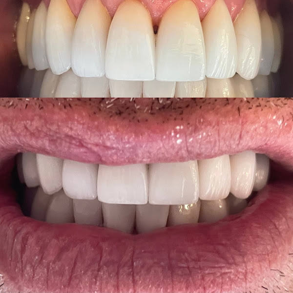 Foto 2 de Implante Dentário | prótese protocolo | Odonto Castro | Dr Eron| Pina | Recife - PE