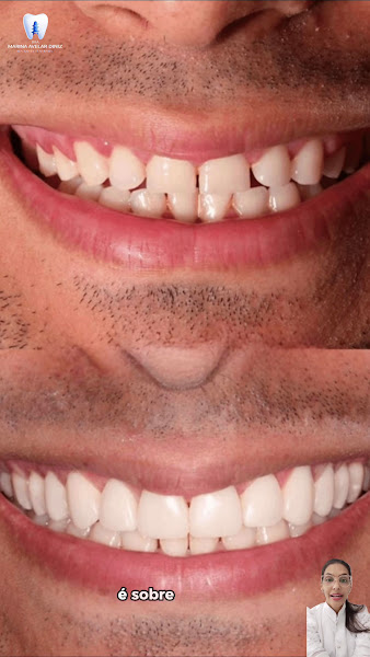 Foto 3 de Implante dentário, Protocolo, Lentes Contato Dental em Sete Lagoas MG - Dra. Marina Diniz