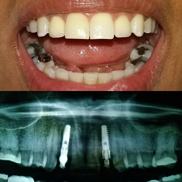 Foto 3 de Implante Dentário Salvador