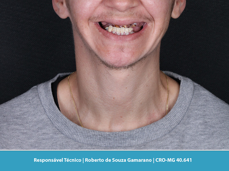 Foto 3 de Implante Dentário | Santé Clínica Odontológica | Dentista em Santo Agostinho - BH