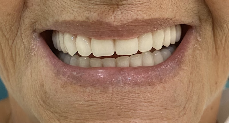 Foto 2 de Implante e Prótese Dentária/ Dra Xênia Roberta