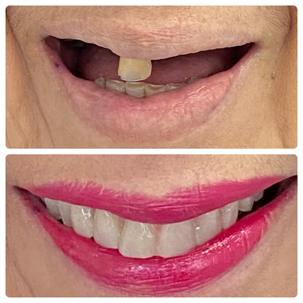 Foto 3 de Implante e Prótese Dentária/ Dra Xênia Roberta