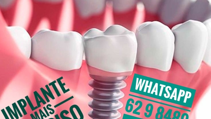 Foto 2 de Implante Mais Sorriso