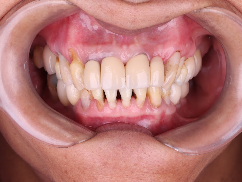 Foto de Implante para todos