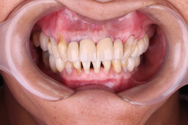 Foto 2 de Implante para todos