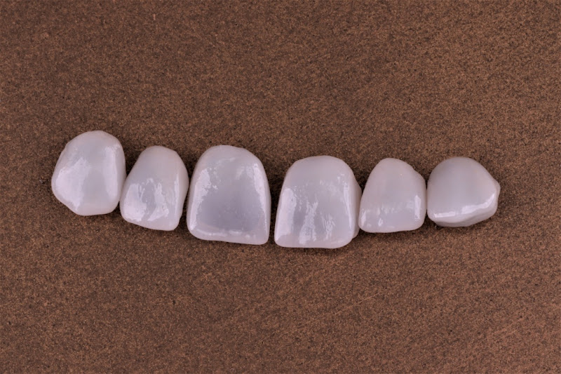 Foto 3 de Implante para todos