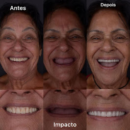 Foto 2 de Implante Prótese tipo Protocolo - Madureira - Rio de Janeiro