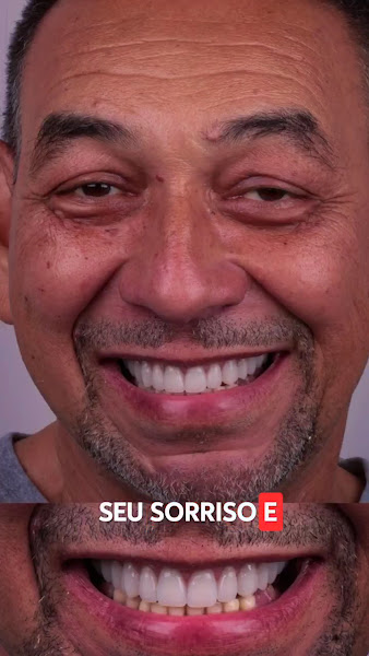 Foto 3 de Implante Prótese tipo Protocolo - Madureira - Rio de Janeiro