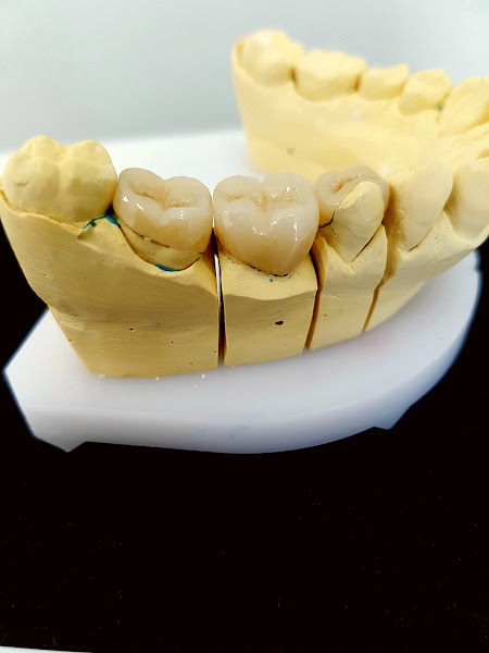 Foto 5 de Implantes Dentários | Aparelho Dentário | Dentista | OdontoPonto | Guaianazes, Guaianases Vila Minerva - SP