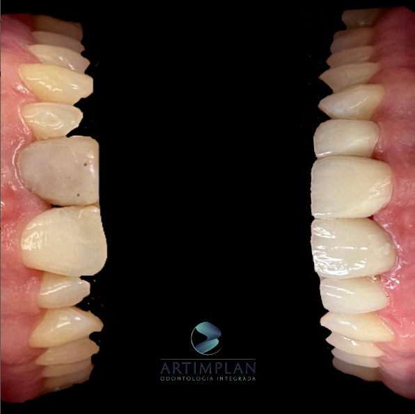 Foto 5 de Implantes dentários | Dentista | Artimplan Odontologia | Zona Norte