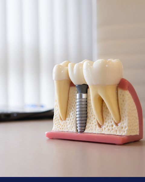 Foto 5 de Implantes Dentários | Dentista | Clínica Coimbra Odontologia | Nova Iguaçu RJ