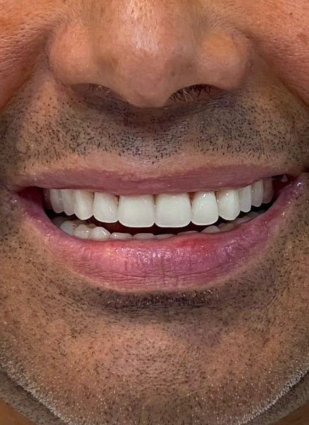 Foto 3 de Implantes Dentários - Dr Felipe Schonrock