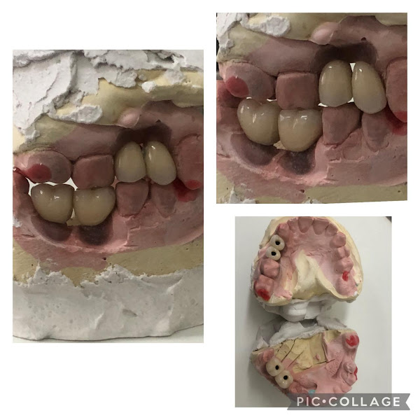 Foto 3 de IMPLANTES DENTÁRIOS - Dr. Ronaldo R. Montini