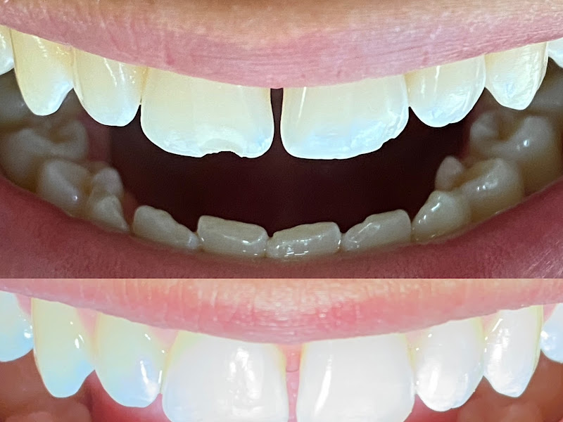 Foto de Implantes Dentários - Dr. Victor Petrin - Dentista